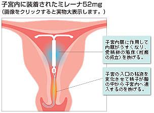 パッチ 通販 避妊