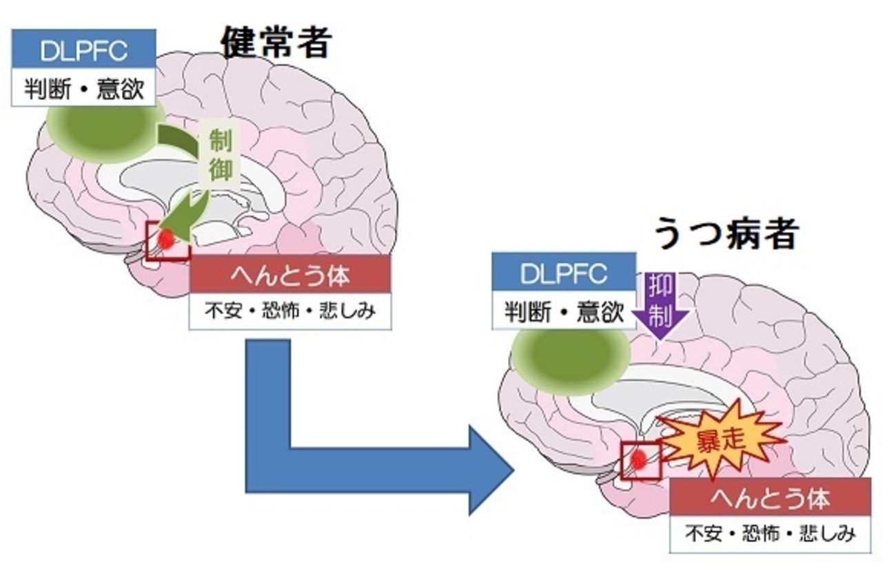 うつ病になると脳が変わる！？ PART2 働きすぎる右脳 - therapilasis 