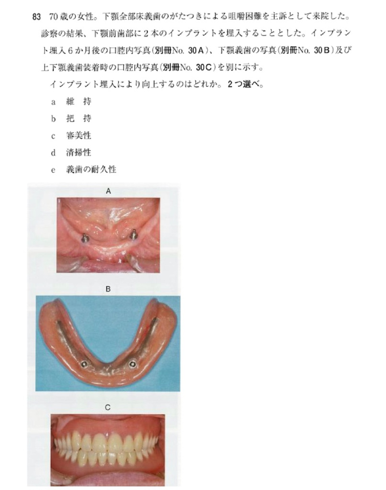 115回歯科医師国家試験【115A-083】義歯 ピエゾグラフィ編 - 歯学部 