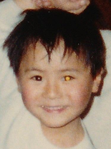 網膜芽細胞腫とは サイエンスの人気 最新記事を集めました はてな