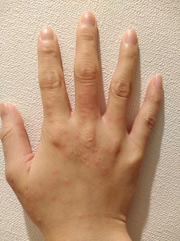 蕁麻疹とは サイエンスの人気 最新記事を集めました はてな 蕁麻疹とは サイエンスの人気 最新記事を集めました はてな