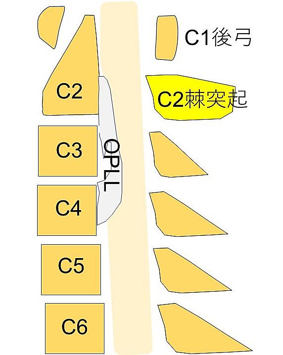 後縦靭帯骨化症とは サイエンスの人気 最新記事を集めました はてな