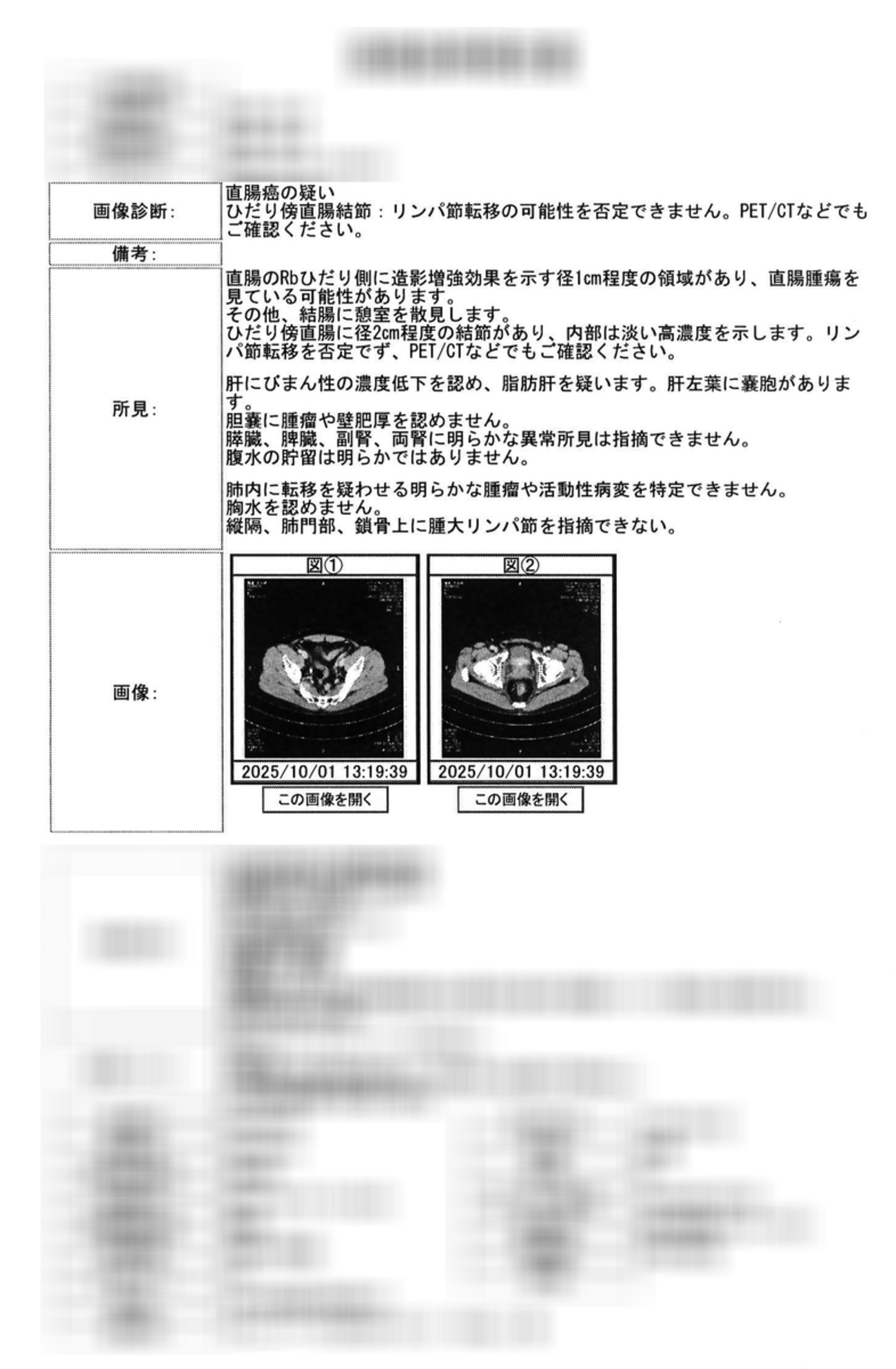 【大腸NETの話】希少がんの神経内分泌腫瘍(NET)ほぼ確定、入院手術即確定 - 関内関外日記