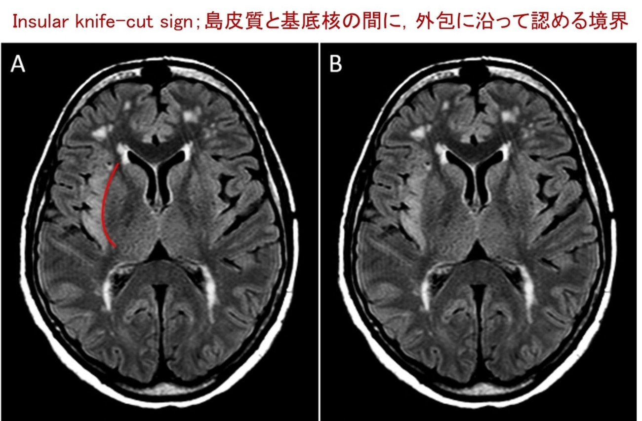 Insular knife-cut signはヘルペス脳炎早期診断の切り札となるか