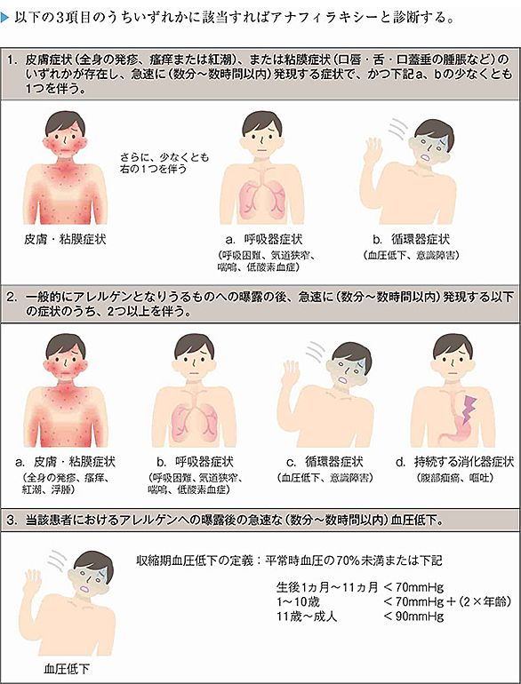 エピペンとは サイエンスの人気 最新記事を集めました はてな