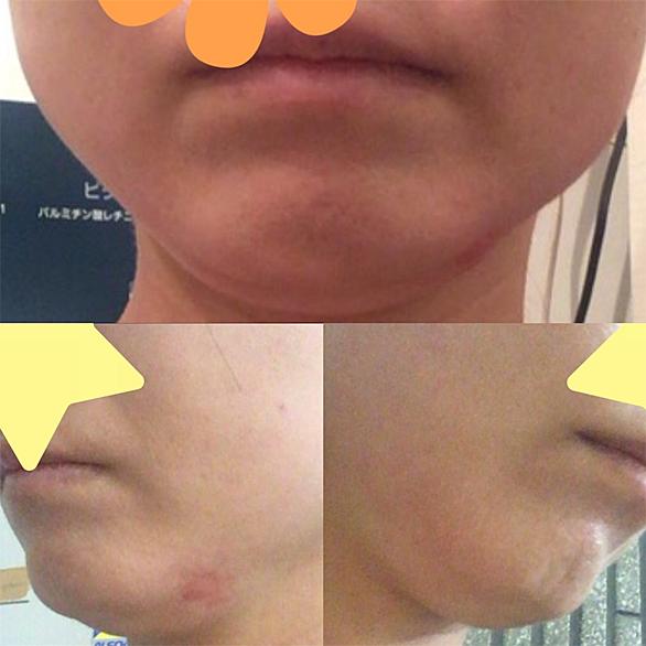 脂肪溶解注射とは 一般の人気 最新記事を集めました はてな