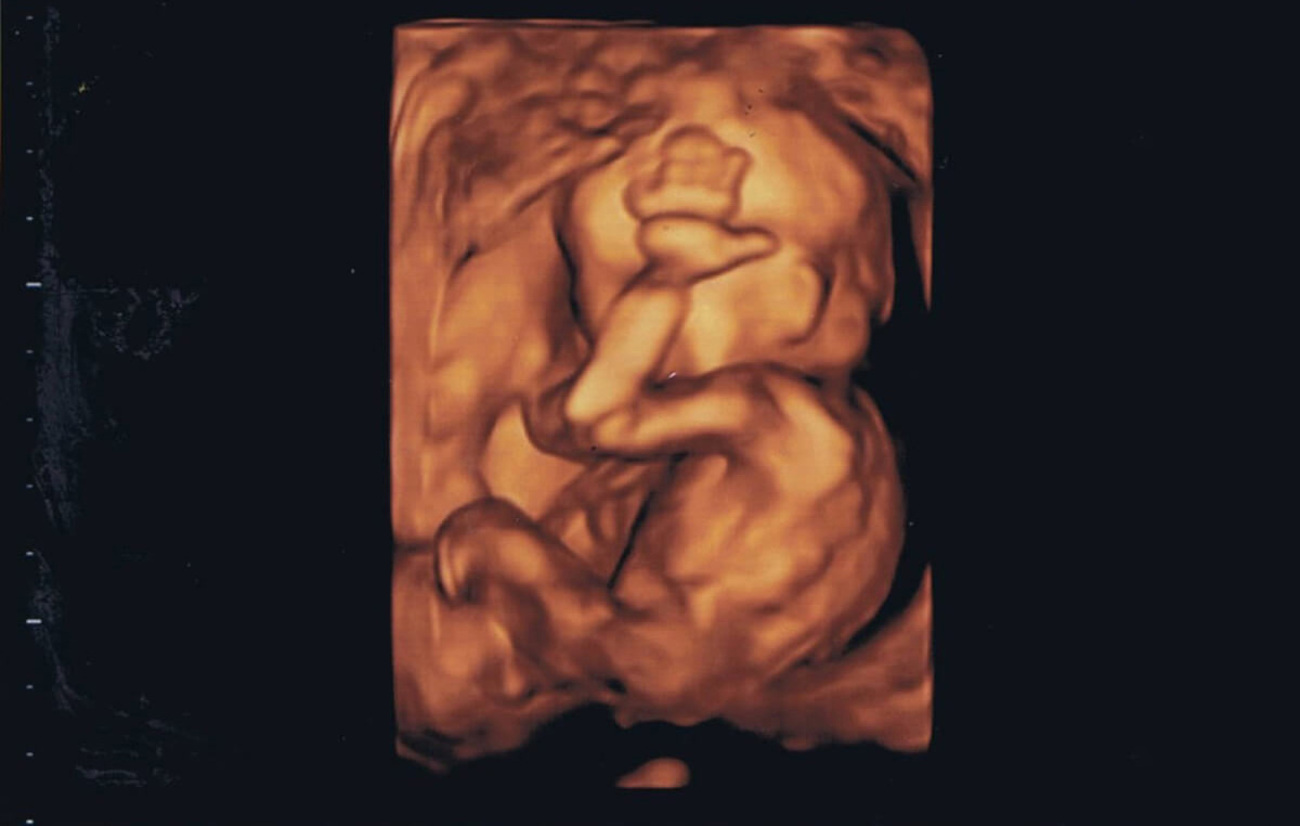 医師監修】妊娠18週（妊娠5ヶ月：妊娠中期）｜ゼクシィBaby
