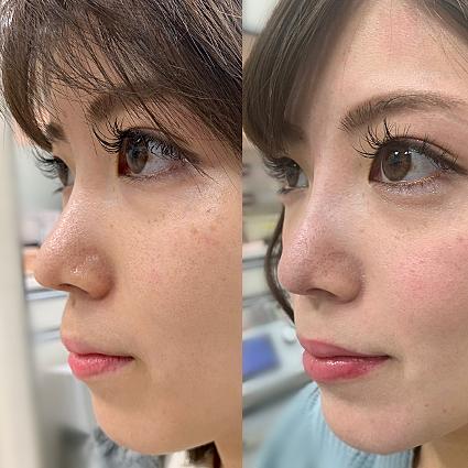 プチ整形とは 一般の人気 最新記事を集めました はてな プチ整形とは 一般の人気 最新記事を集めました はてな