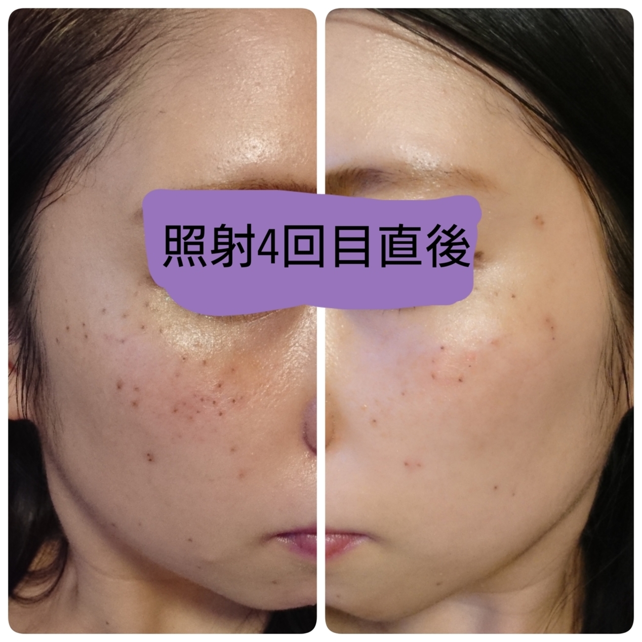 低周波ペンシルでシミを取ってみた！⑧】照射4回目～照射直後と