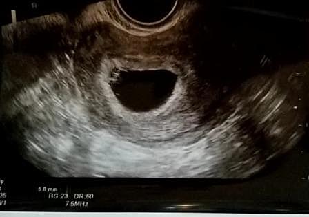 妊娠 初期 心拍弱いとは 人気 最新記事を集めました はてな