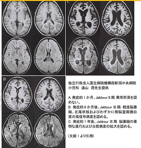 脱髄疾患 (サイエンス) 人気・最新記事が見つかる!わかる! はてなブログ タグ