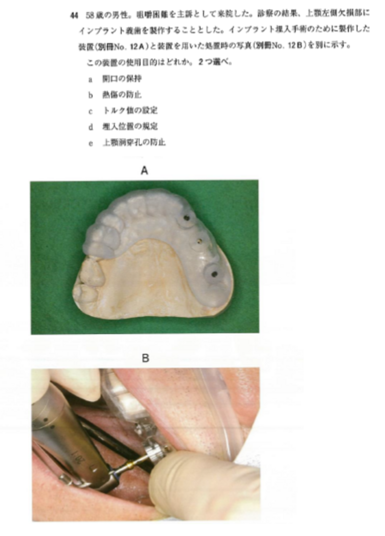 116回歯科医師国家試験【116D-44】歯冠補綴学：インプラントの