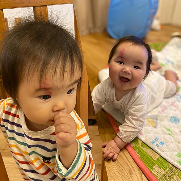 単純性血管腫とは 一般の人気 最新記事を集めました はてな 単純性血管腫とは 一般の人気 最新記事を集めました はてな