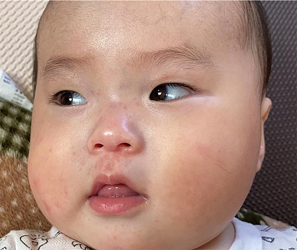 蕁麻疹とは サイエンスの人気 最新記事を集めました はてな 蕁麻疹とは サイエンスの人気 最新記事を集めました はてな
