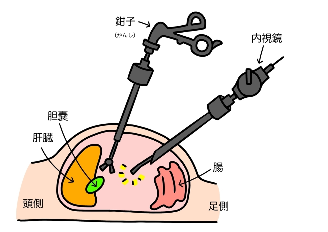 腹壁吊り上げ法による腹腔鏡下胆嚢摘出術 スム-ズな手術を行うためのノウハウ/南山堂/橋本大定（ペーパーバック） 腹壁吊り上げ法による腹腔鏡下胆嚢摘出術 スム-ズな手術を行う