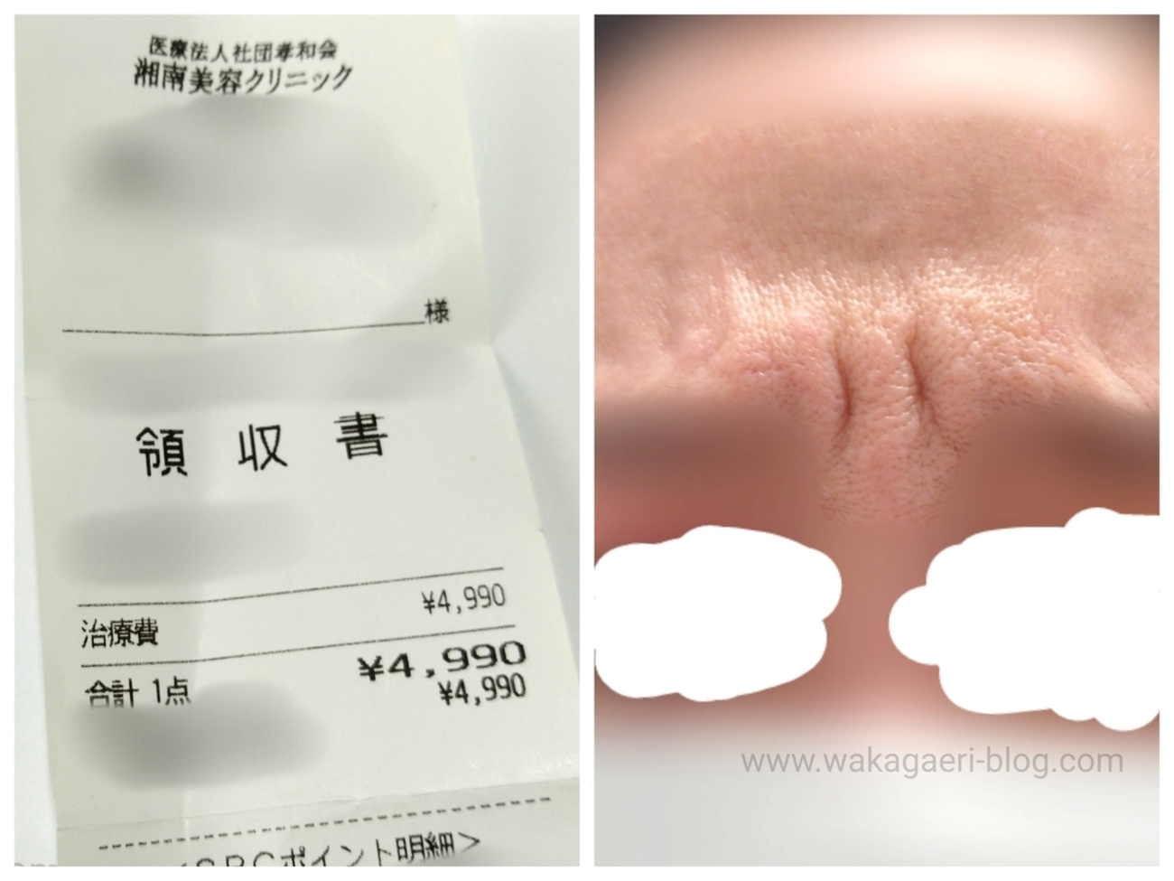 湘南美容】激安4990円！眉間シワ取りボトックス(アラガン)打ってみた
