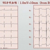 コラム094：12誘導心電図での校正波(1/2,1/4表示について)