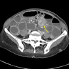 症例85：腹部手術歴がある76歳女性に生じた腹部膨満/腹痛（J Am Coll Emerg Physicians Open. 2020 Sep 27;1(6):1740-1741.）