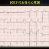 ECG-213：100才代女性。CLBBB波形で、V6にS波があるんデス。