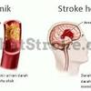 Obat Stroke Adalah