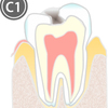虫歯治療について