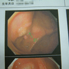 大腸の内視鏡検査　一年後