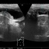 胆嚢腫瘍の超音波画像。胆嚢癌エコー像と肝転移。