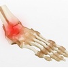 足関節捻挫を起こしたら？　足関節捻挫の種類、症状や基本処置