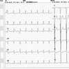 ECG-097：81才男性。心不全を繰り返す。