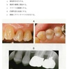 115回歯科医師国家試験【115B-58】保存修復学　窩洞外形編