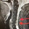 頚椎の診断が出た