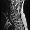 頚椎後縦靱帯骨化症（MRI画像）