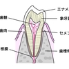 歯のヒビ