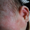 息子の顔の湿疹①～乳児湿疹に振り回される～