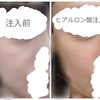ゴルゴラインはヒアルロン酸が何㏄で消える？ビフォーアフター