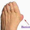 Foot Bunions Causes