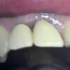前歯の歯根破折（咬合高径の低下による下顎前歯の突き上げ）