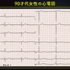 ECG-209：90才代女性。徐脈です。