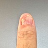 グロームス腫瘍摘出手術：術後182日目。これもう爪は生えてこないのでは？