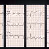 【ECG184】90代女性。呼吸苦での搬入でした。