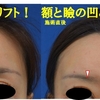 厚労省承認新ヒアルロン酸（ボリフト）注射で額のボリュームアップとまぶたの凹みを治しました。