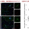 ミクログリアとシナプス：進行性核上性麻痺の病態理解を深める２つの研究