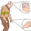 Bệnh Parkinson: Hiểu nguyên nhân, triệu chứng sẽ có cách trị hiệu quả