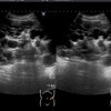 腎のう胞。多発性嚢胞腎のエコー画像。