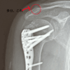 手術した総合病院での最後の診察。あー－、上腕骨近位端骨折ロス。プレート、外すことも出来たらしいけれど、結局、外さないことに・・・（完）