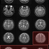 頭頂の脳回の読み方　MRI・CT　頭頂間溝の探し方