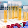 Urinalysis Market Growing at a rapid pace in the Foreseeable Future