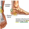 Dealing With Heel Spur