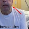 Fly catcher tongue，Bonbon sign，舌ミオリズミア，舌ポリミニミオクローヌス・・・舌の異常運動から診断する神経疾患