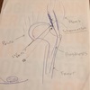 昨日のDr. Bの見解（人工股関節術後の炎症）